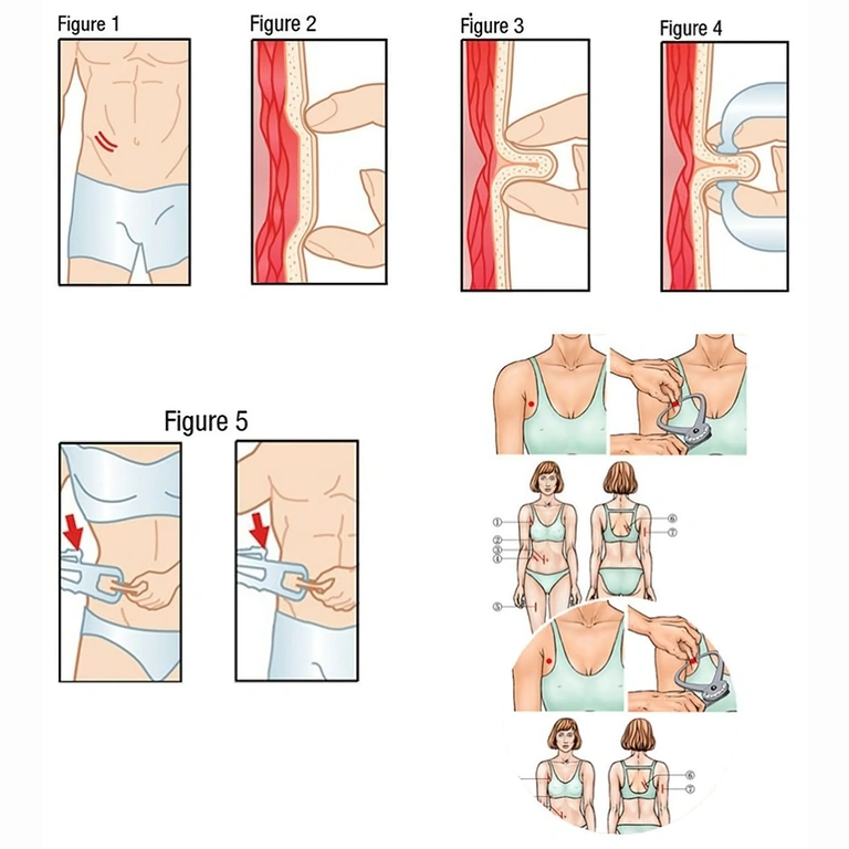 Οδηγίες χρήσης πτυχιόμετρου για μέτρηση πτυχών δέρματος